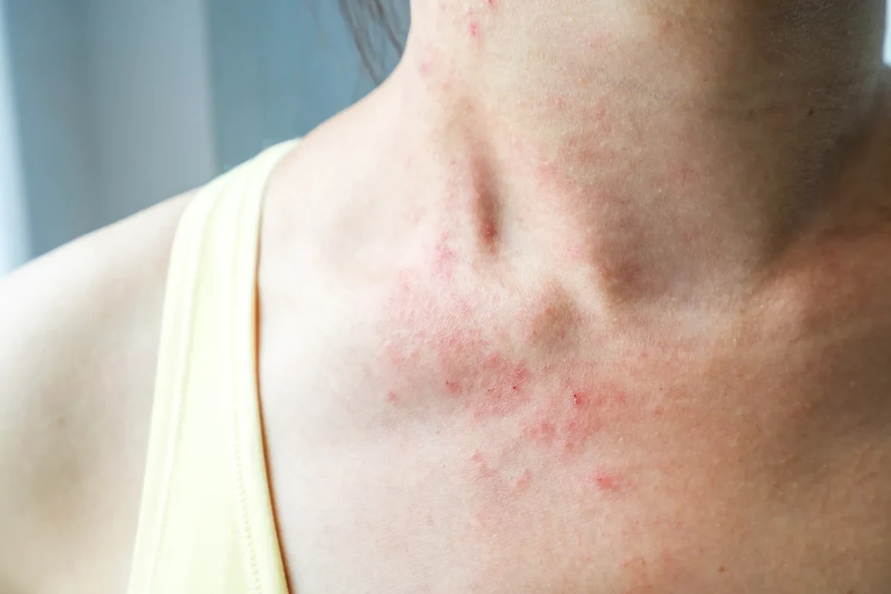 Image pour l'article Problèmes de peau et hypnose : comment ça marche ?