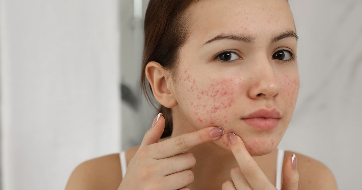 Image pour l'article Acné : les solutions naturelles des naturopathes